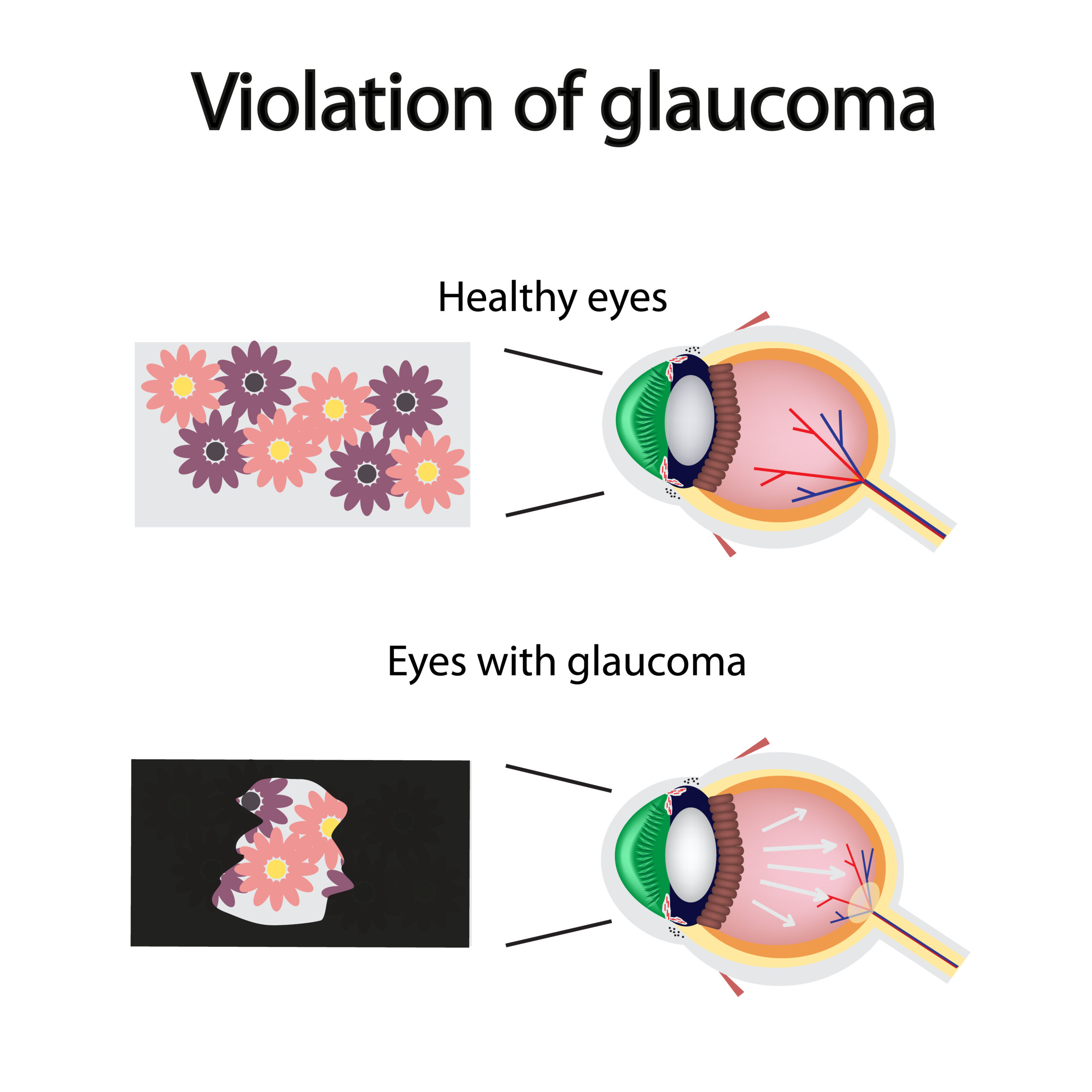Violation of Glaucoma