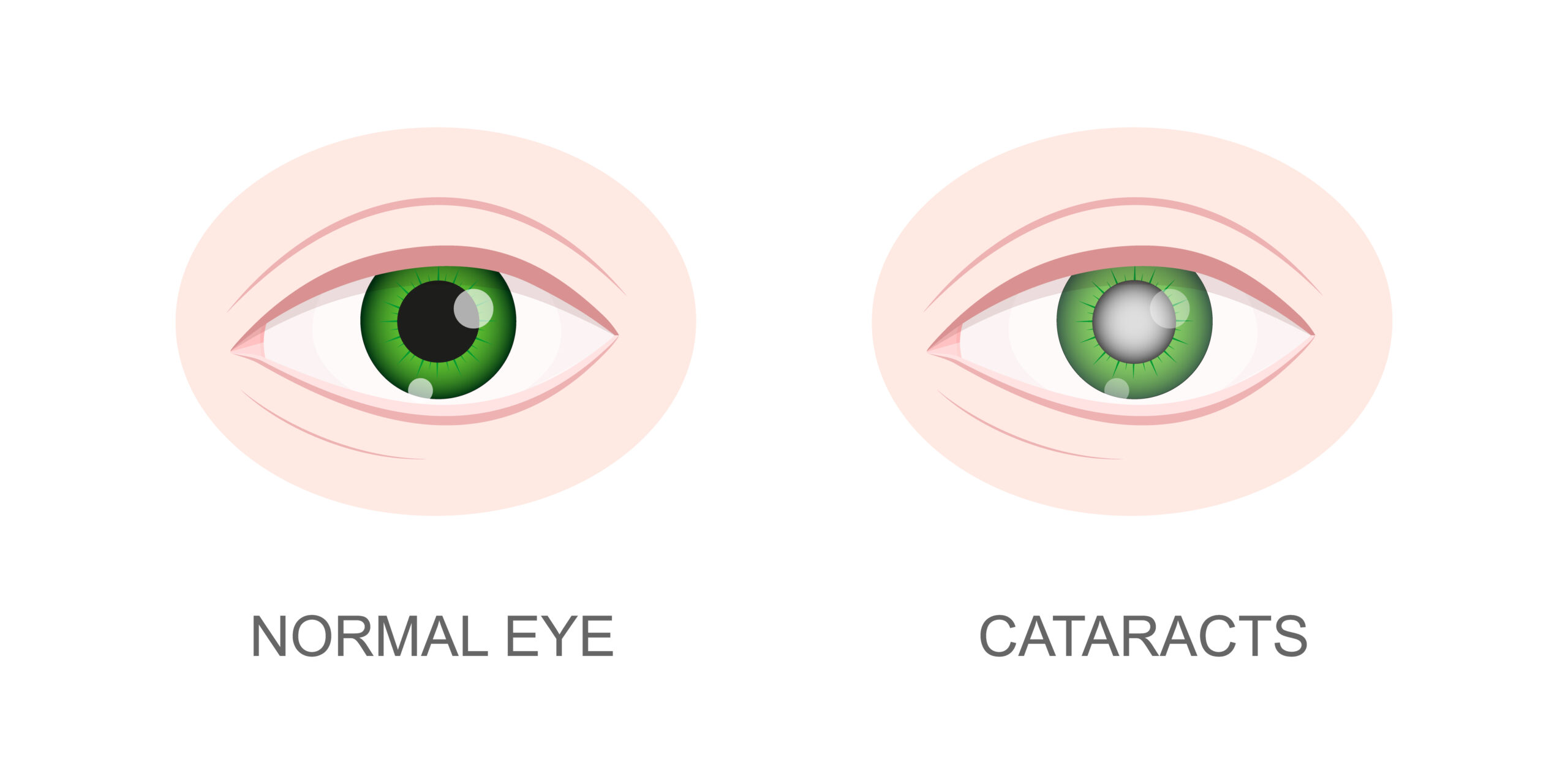 Cataract Symptoms