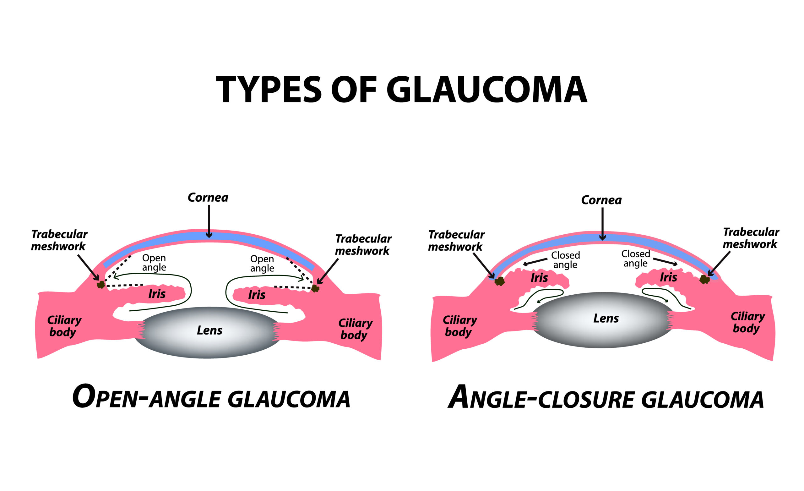 Types of Glaucoma