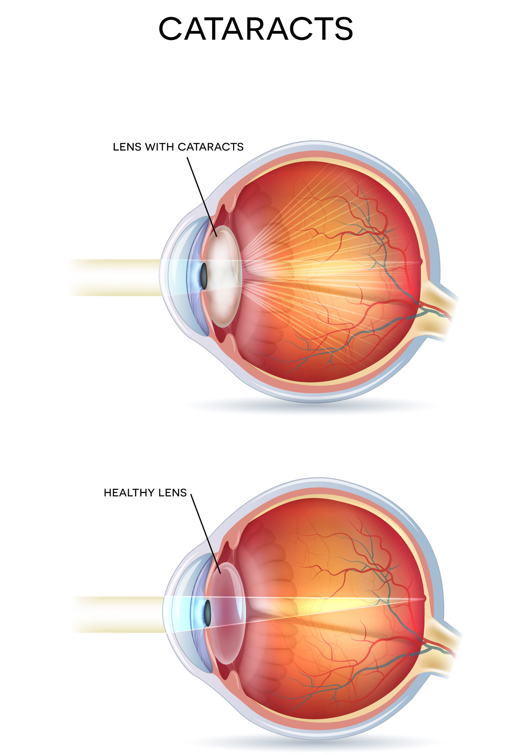 Cataract